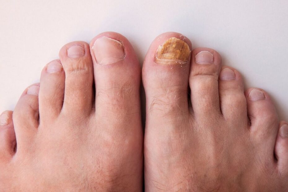 toenail fungus